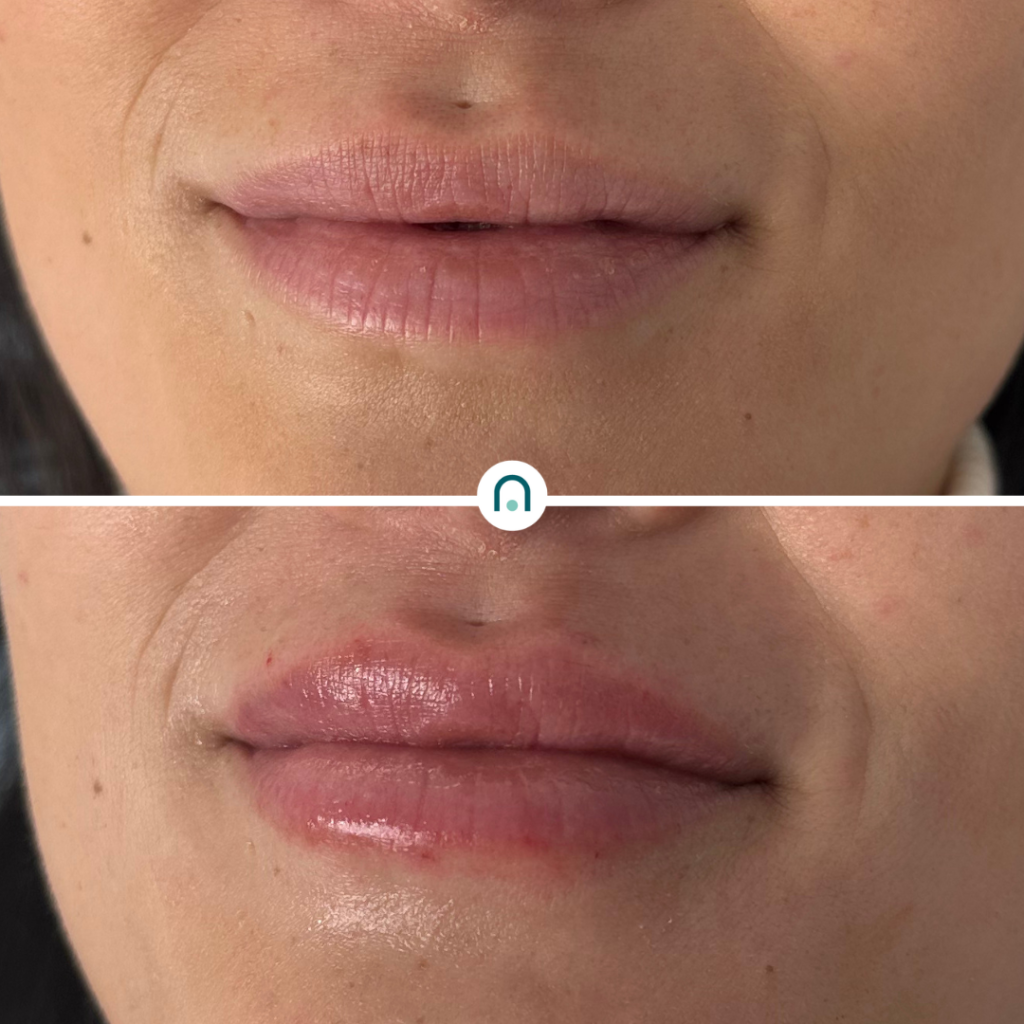 Antes y después labios (1)