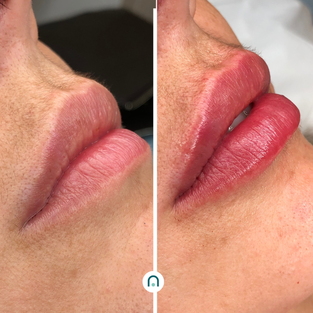 Antes y después labios (2)