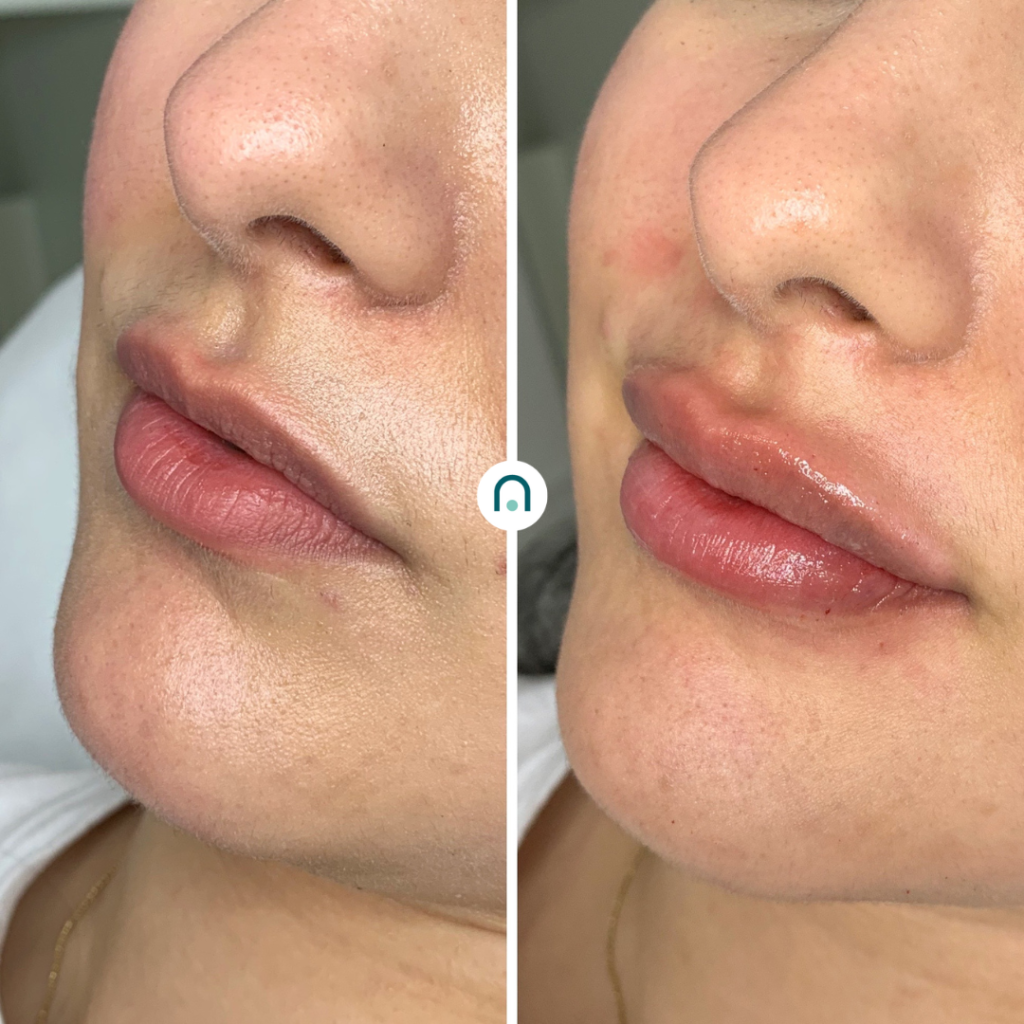 Antes y después labios (3)