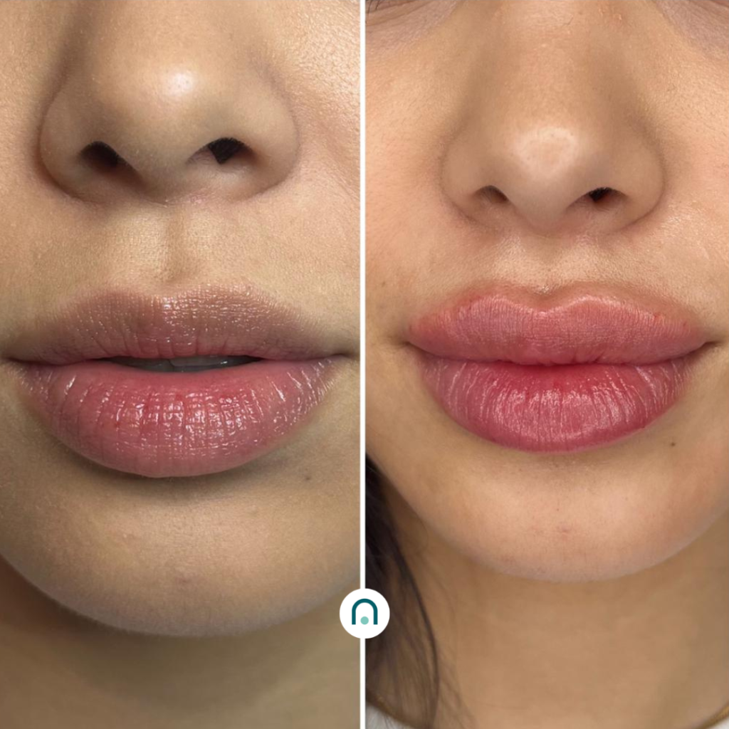 Antes y después labios (4)