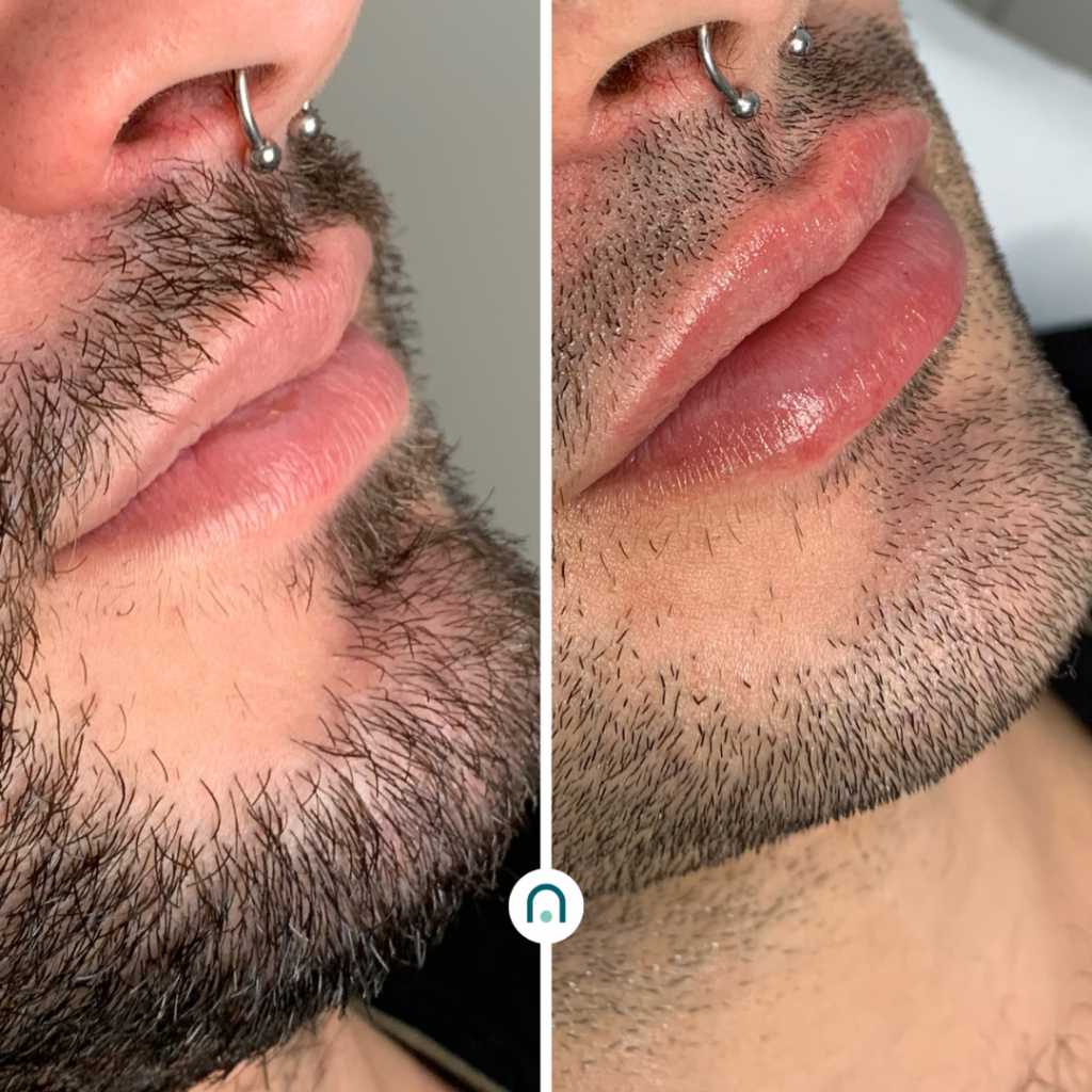 Antes y después labios (5)