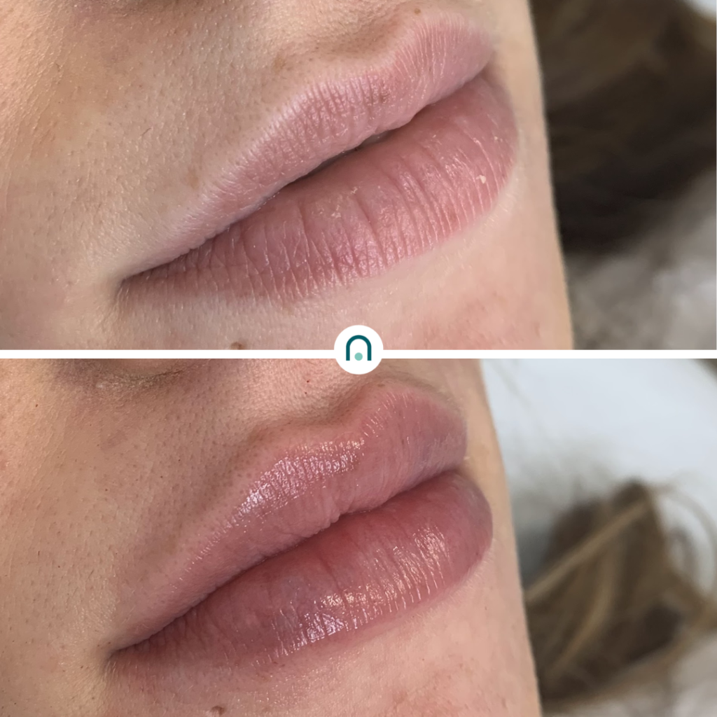 Antes y después labios (9)