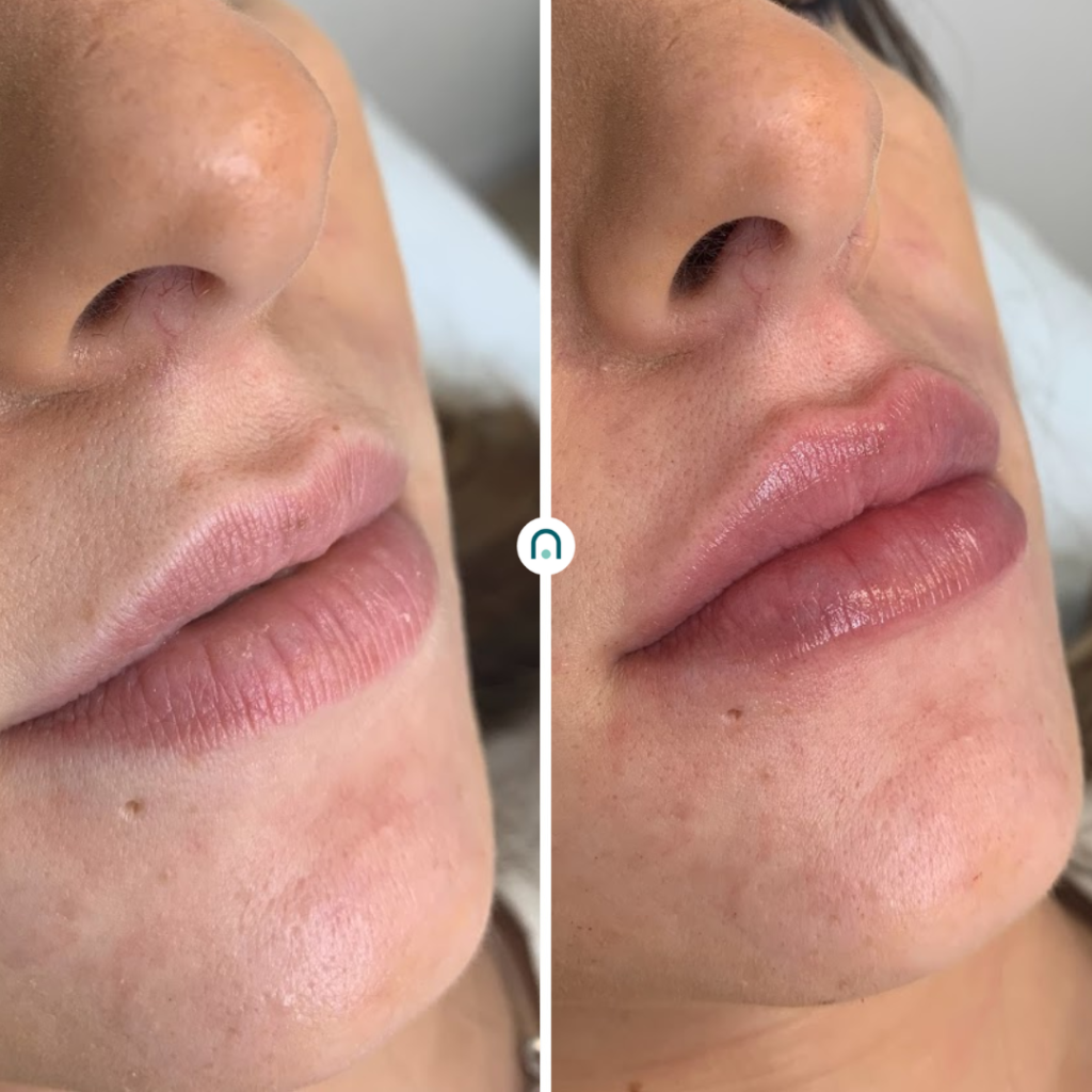 labios antes y después (2)